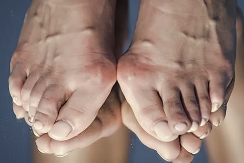 Hallux Valgus o juanetes